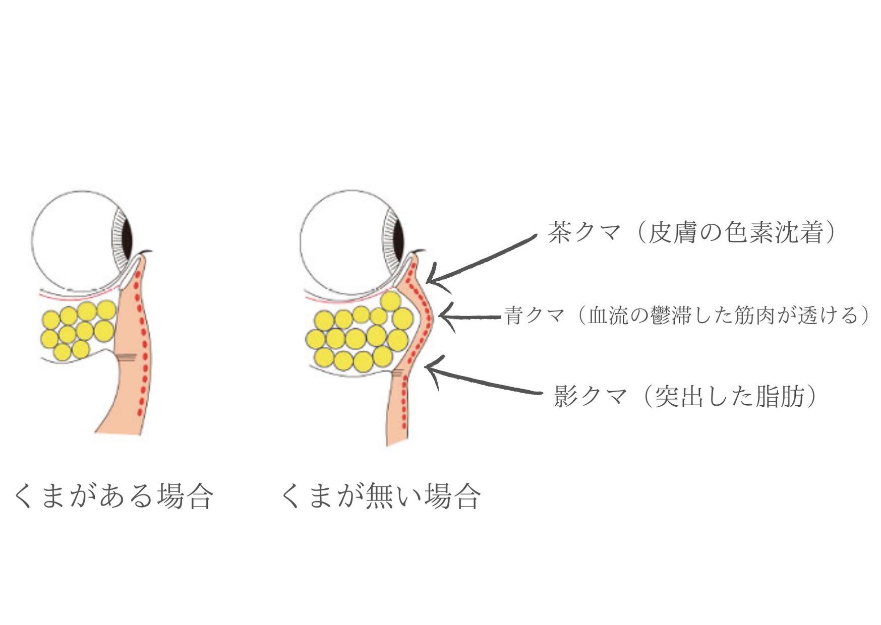 目のくま Junclinic白金 ジュンクリニックは東京白金にある美容皮膚科 美容外科 形成外科です