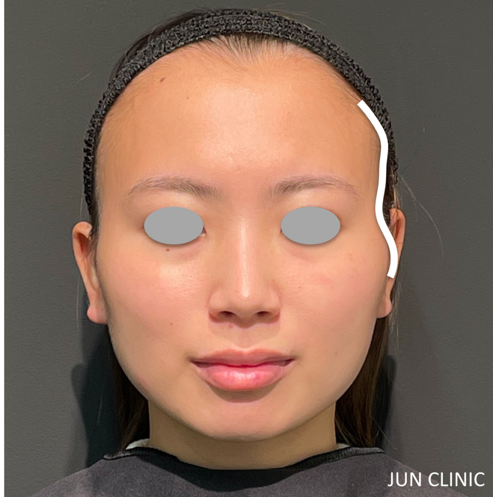 輪郭を整えて小顔に Jun Clinic 白金